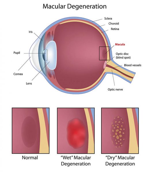 A clinical illustration showing parts of the eye, highlighting the macula and showing normal, wet and dry macular degeneration.
