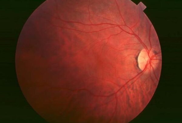 Scientific photo of an eye with retinitis pigmentosa