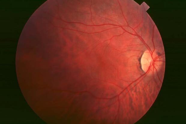 Scientific photo of an eye with retinitis pigmentosa