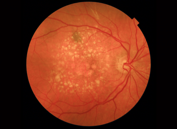 Fundoscopic photograph of a retina showing macular degeneration.