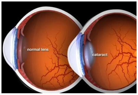 Illustration of an eye with a normal lens and an eye with a cataract